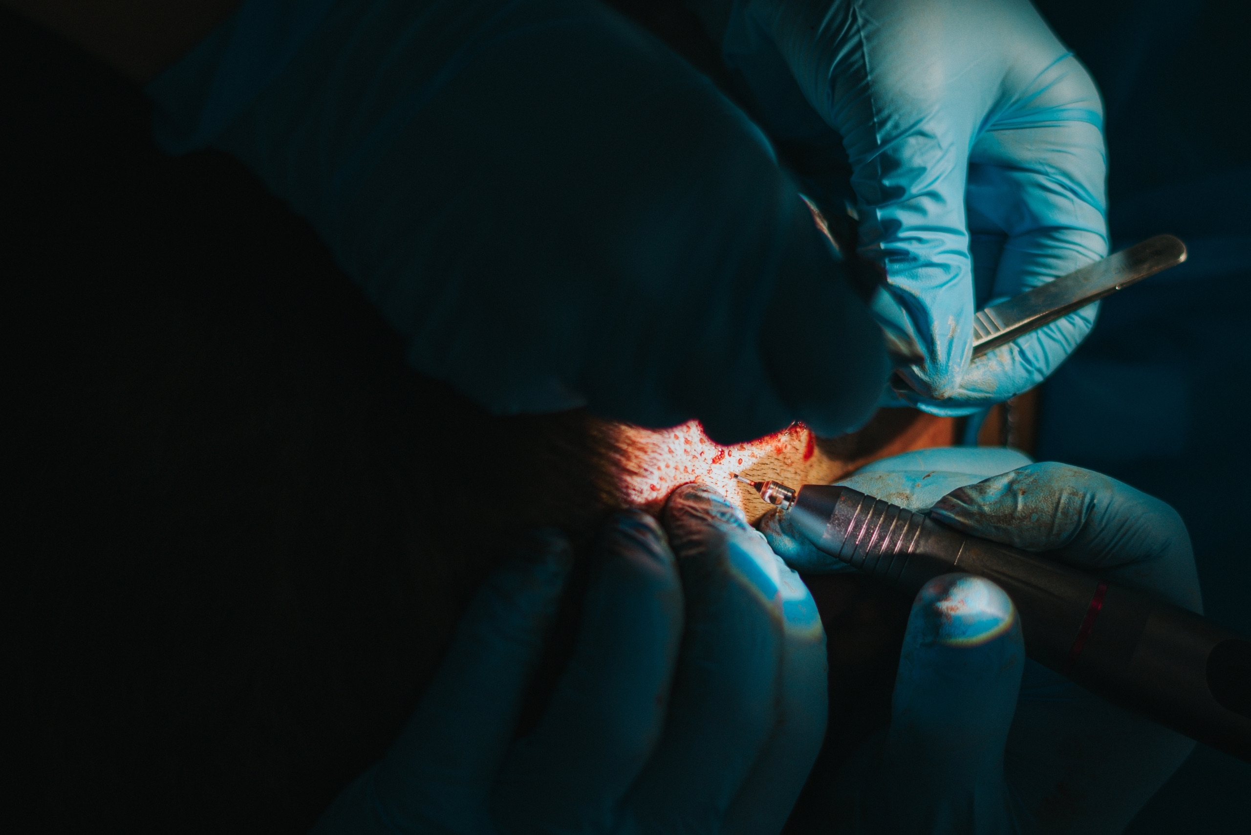 Close-up view of follicular unit excision during an FUE hair transplant procedure