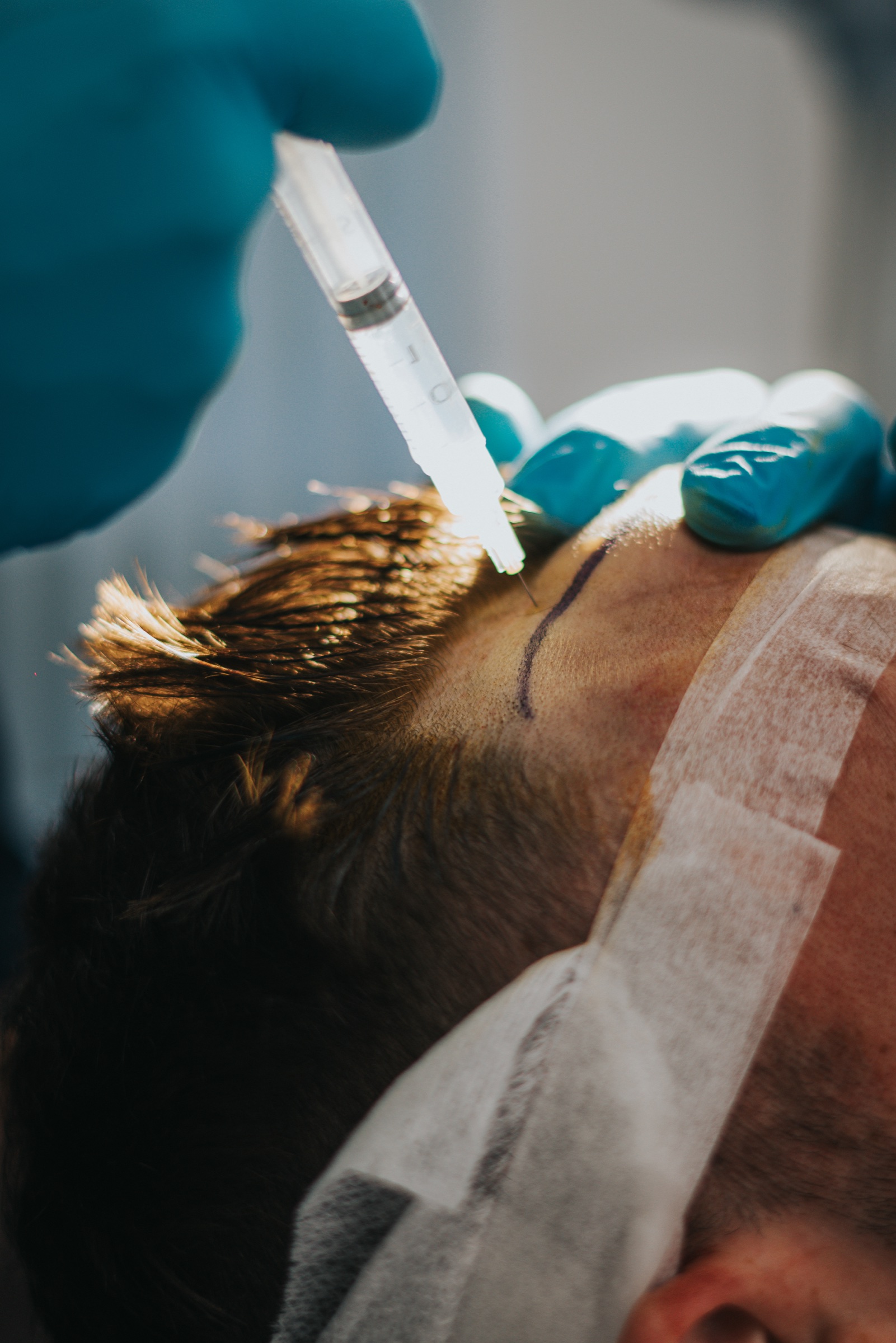 Local anaesthetic being administered before a hair transplant procedure