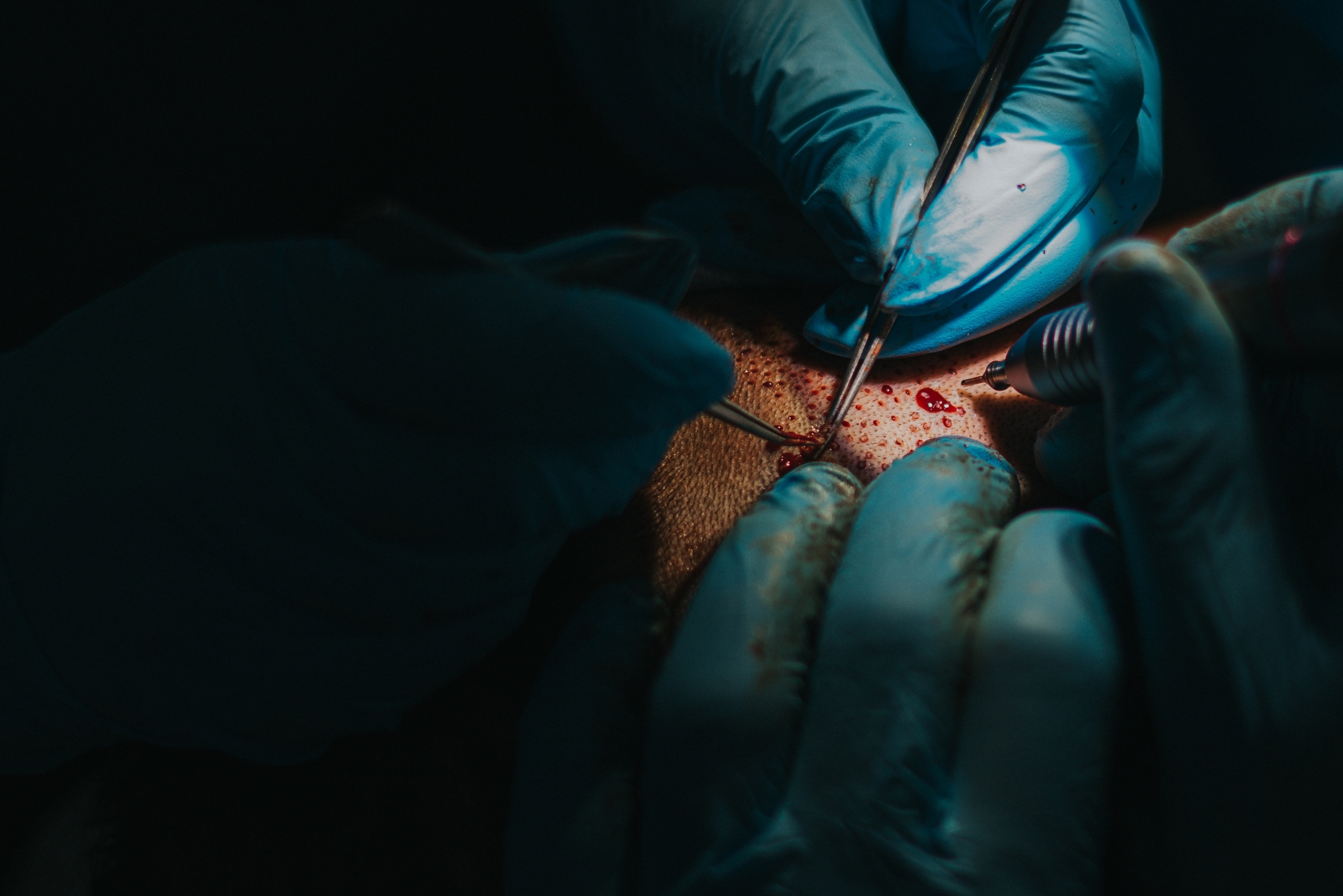 Close-up view of graft extraction during an FUT hair transplant procedure