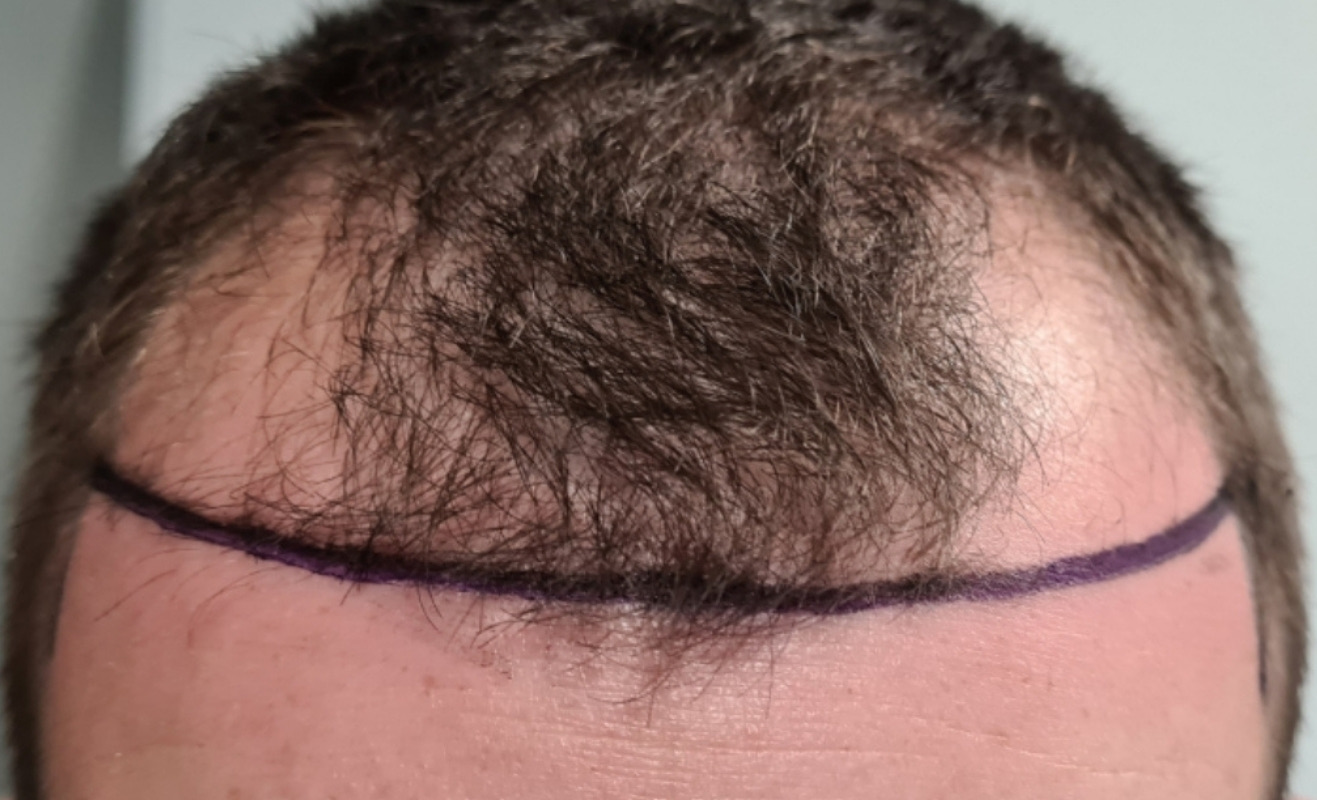 Proposed hairline marked before an FUT hair transplant procedure
