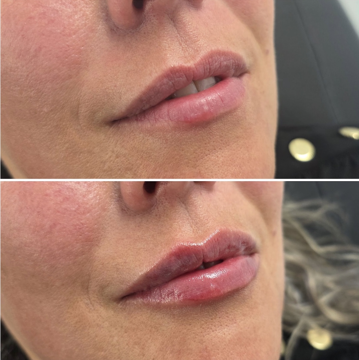 Patient’s lips before treatment, above, and after lip filler, below, supplied by Dr Jamie