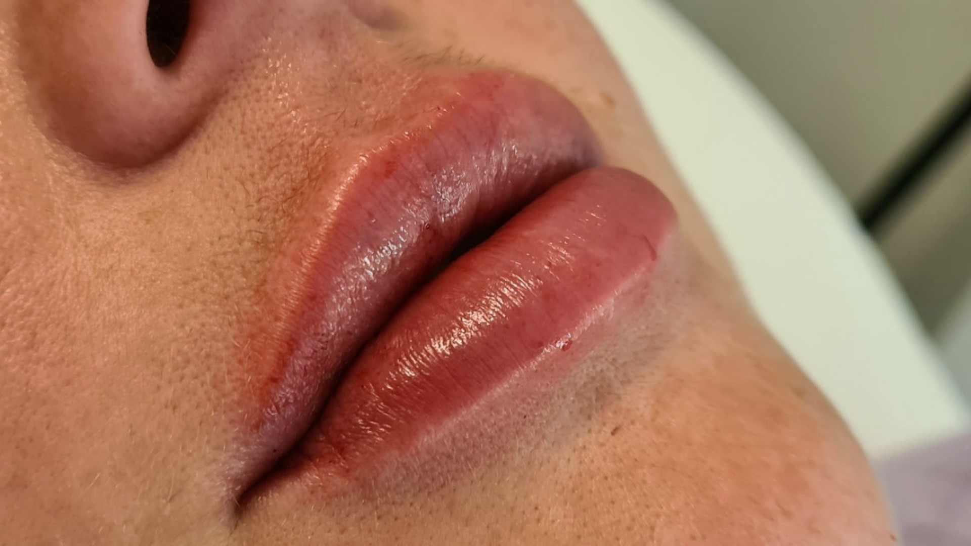 Close view of lips immediately following carefully placed filler treatment